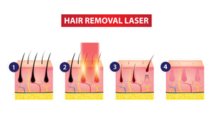 GentleMax Pro -  Laser Hair Removal  (Large Area 3 Session Package)